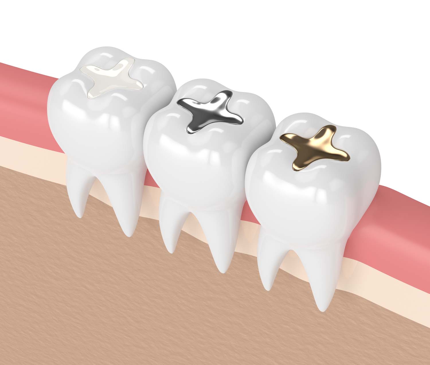 dental restoration